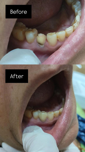 before after