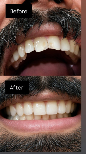 before after