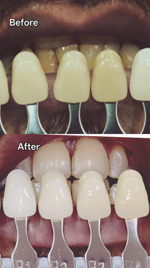 before after
