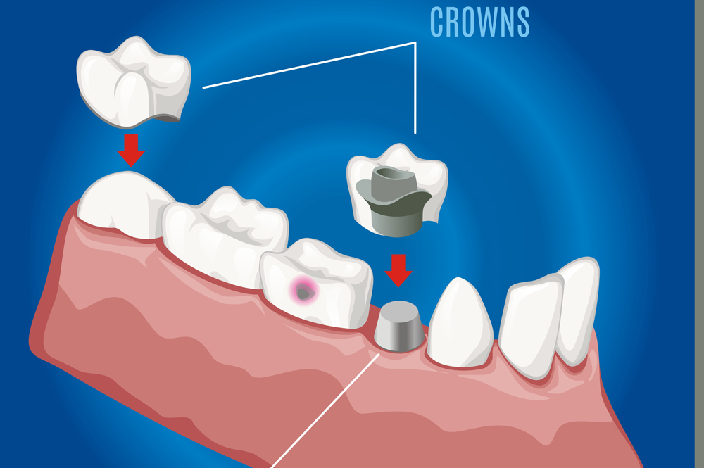 Dental Bridge