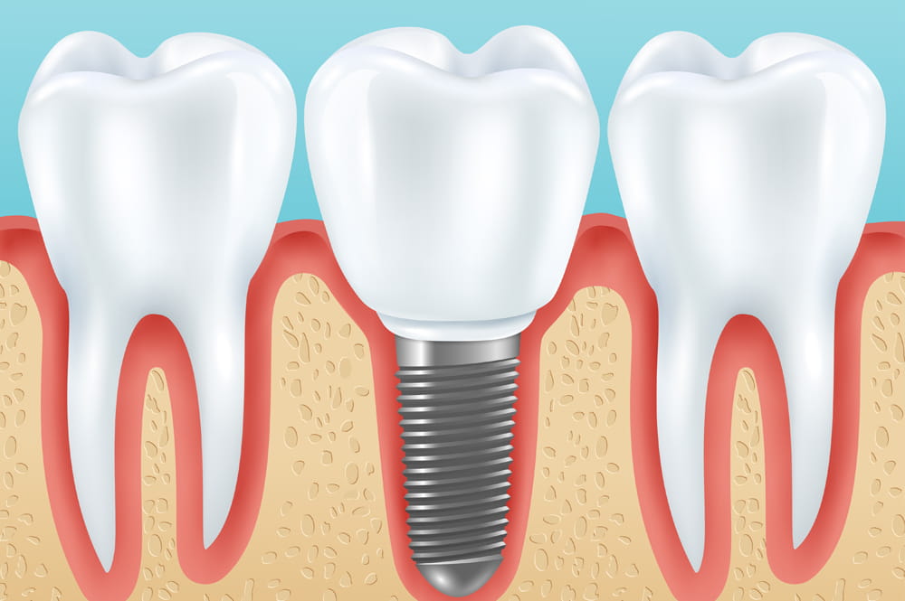 Dental Implant